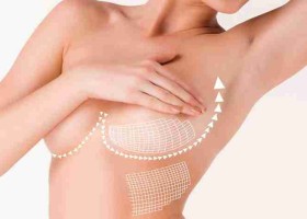 7 câu hỏi thường gặp trước khi phẫu thuật nâng ngực