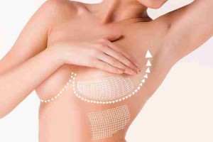 7 câu hỏi thường gặp trước khi phẫu thuật nâng ngực