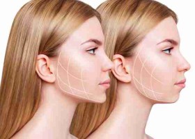 Có nên tiêm tạo hình khuôn mặt bằng filler? Ưu và nhược điểm là gì?