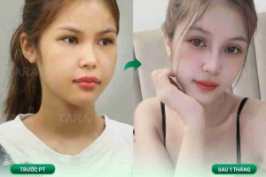 Bác sĩ giải đáp: Có nên cắt mí và nâng mũi cùng lúc?