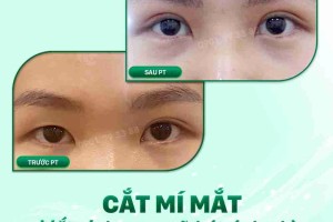 Đâu là địa chỉ cắt mí đẹp tại TPHCM