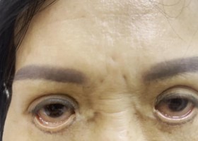 Tại TPHCM, sửa mí hỏng ở đâu thì đẹp?