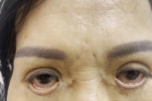 Tại TPHCM, sửa mí hỏng ở đâu thì đẹp?