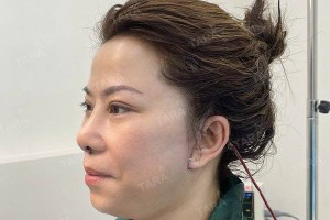 Căng da mặt nội soi là gì? Thực hiện như thế nào?