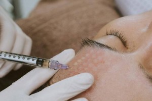 Tiêm căng bóng trẻ hoá da có nguy hiểm không?