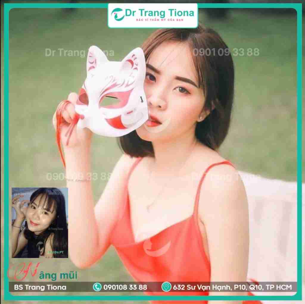 nâng mũi cấu trúc nâng mũi cấu trúc