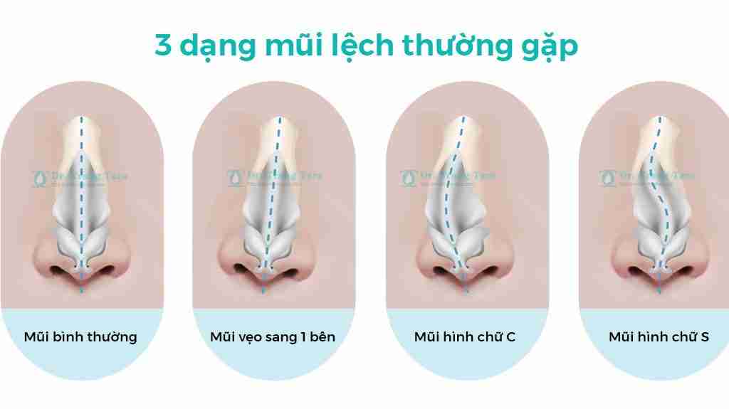 khắc phục mũi lệch vẹo