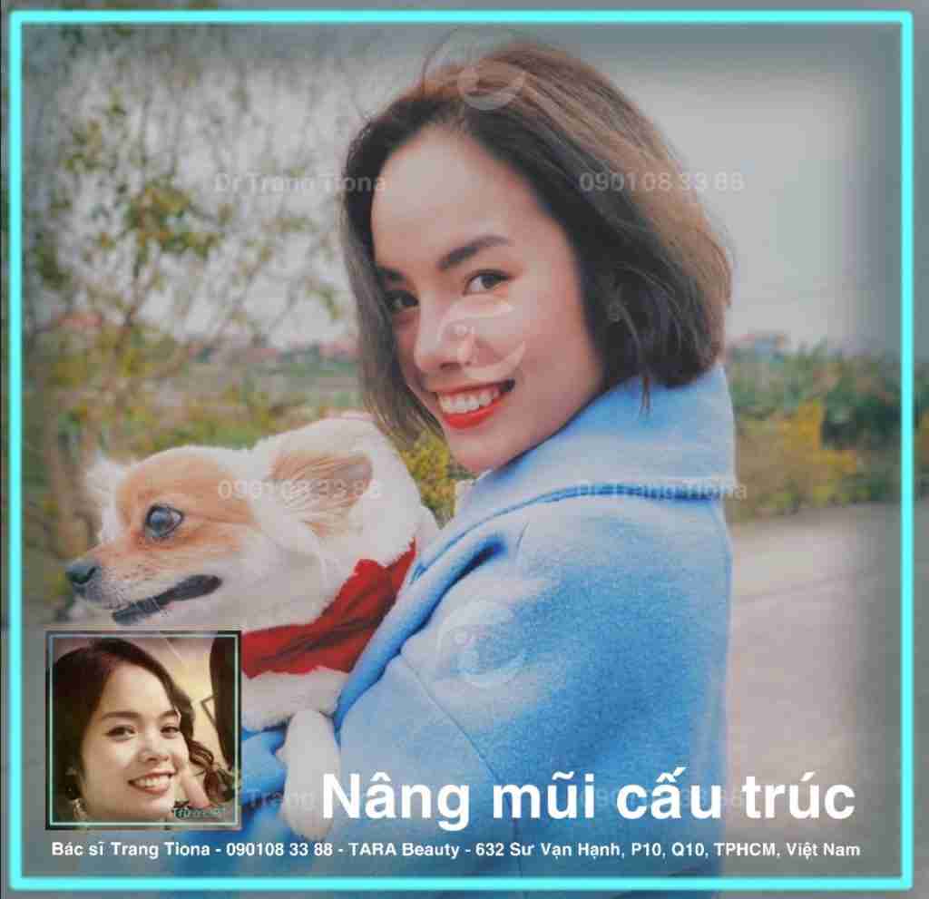 nâng mũi cấu trúc nâng mũi cấu trúc