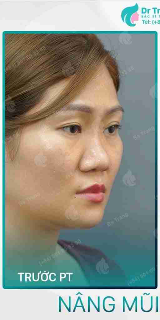 nâng mũi bọc sun Bác sĩ Trang