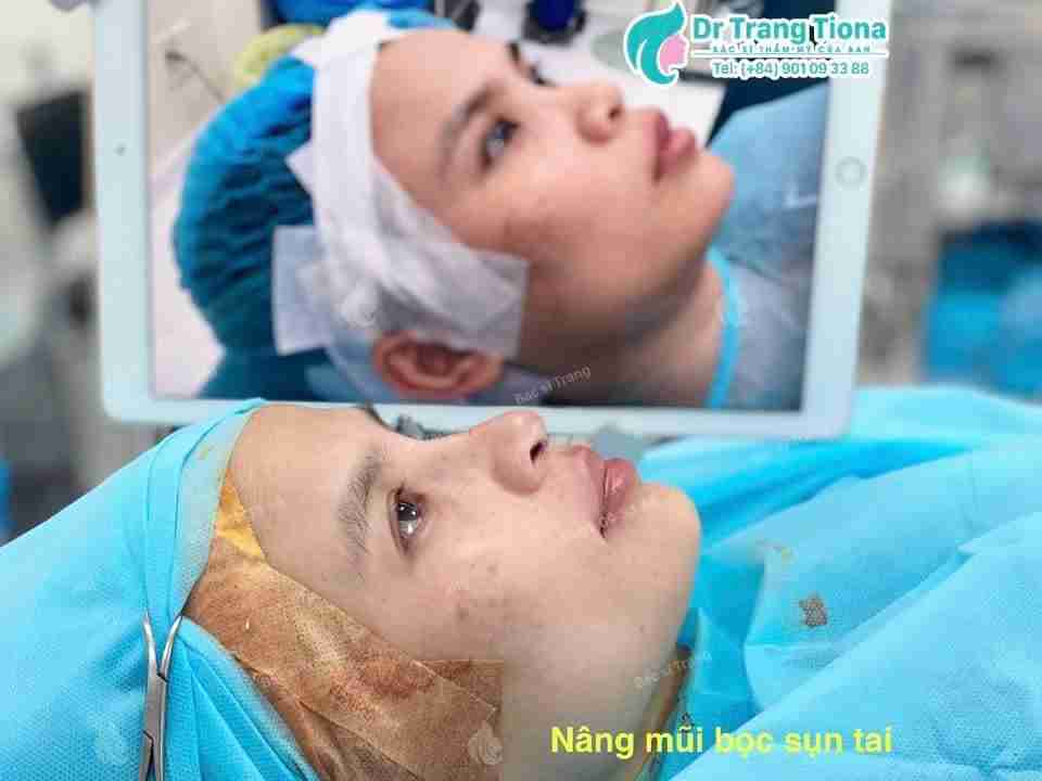nâng mũi bọc sụn tai Bác sĩ Trang
