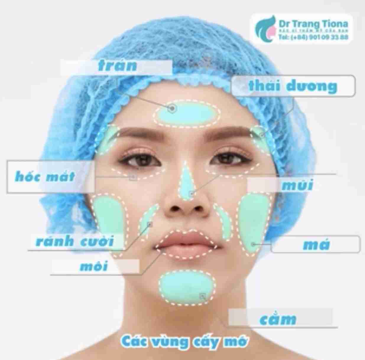 Cấy mỡ mặt 