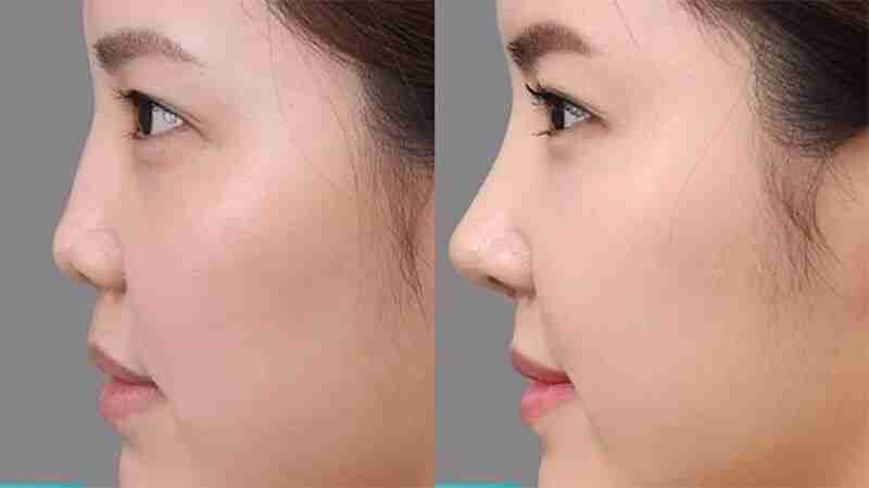 chỉnh sửa mũi hếch