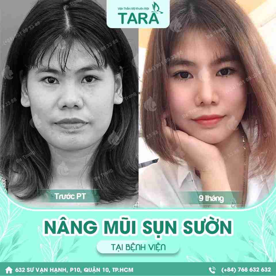 nâng mũi sụn sườn