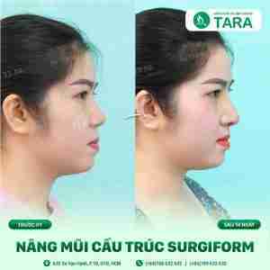 nâng mũi cấu trúc nâng mũi cấu trúc
