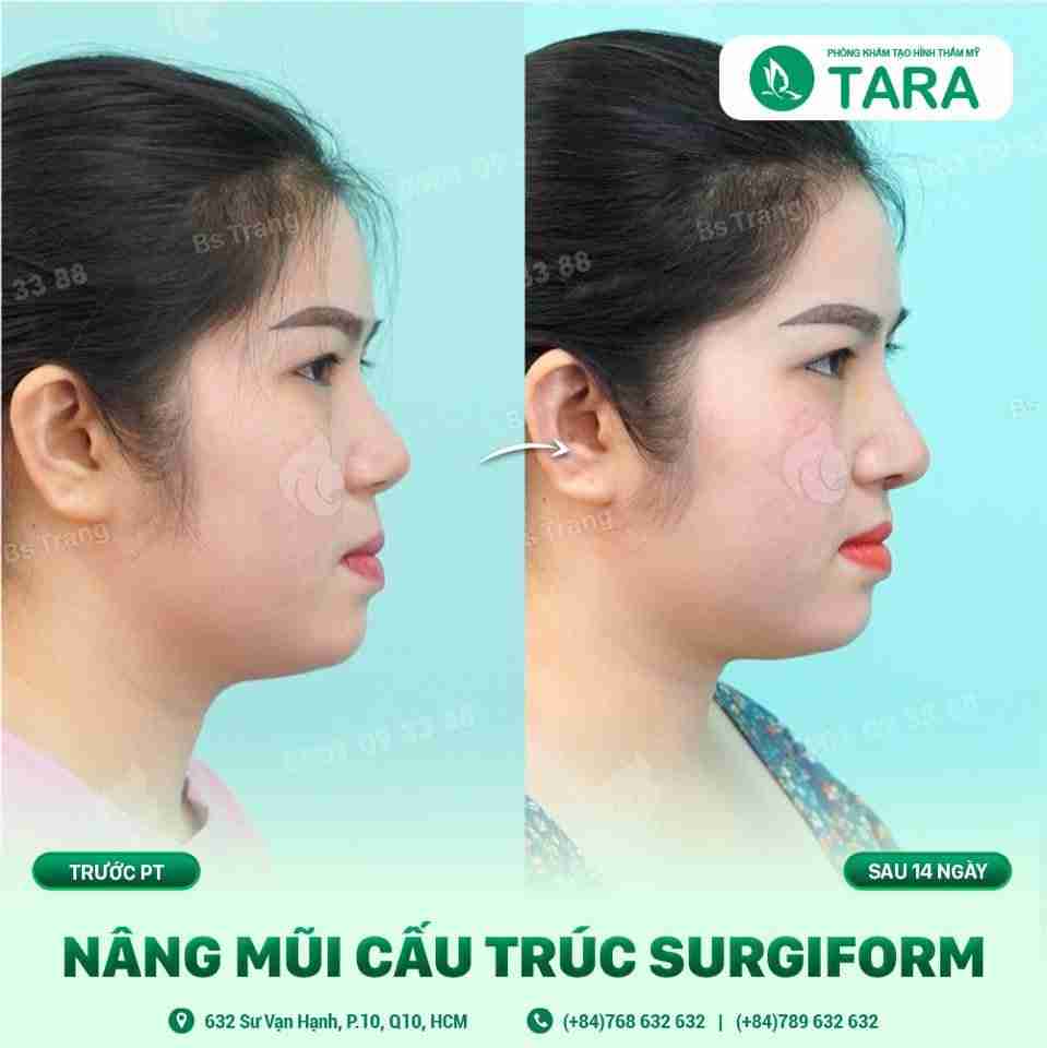 nâng mũi sụn sườn