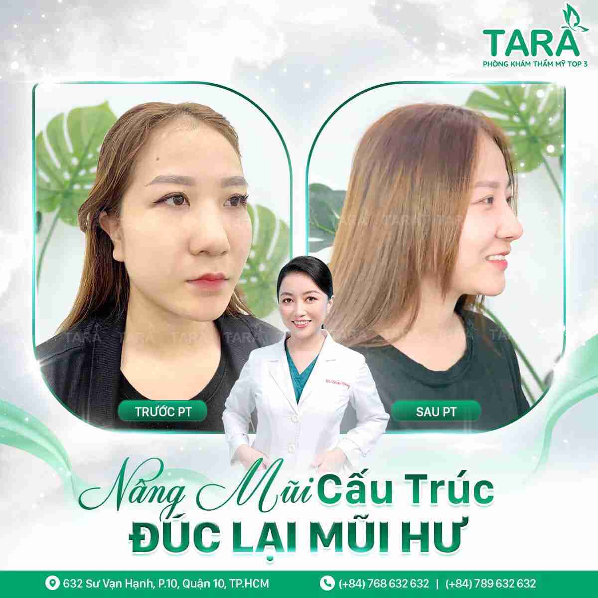 Nâng mũi sụn tự thân Nâng mũi sụn tự thân