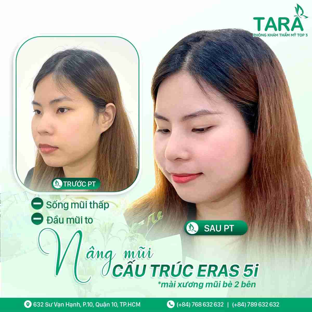 Thẩm mỹ mũi