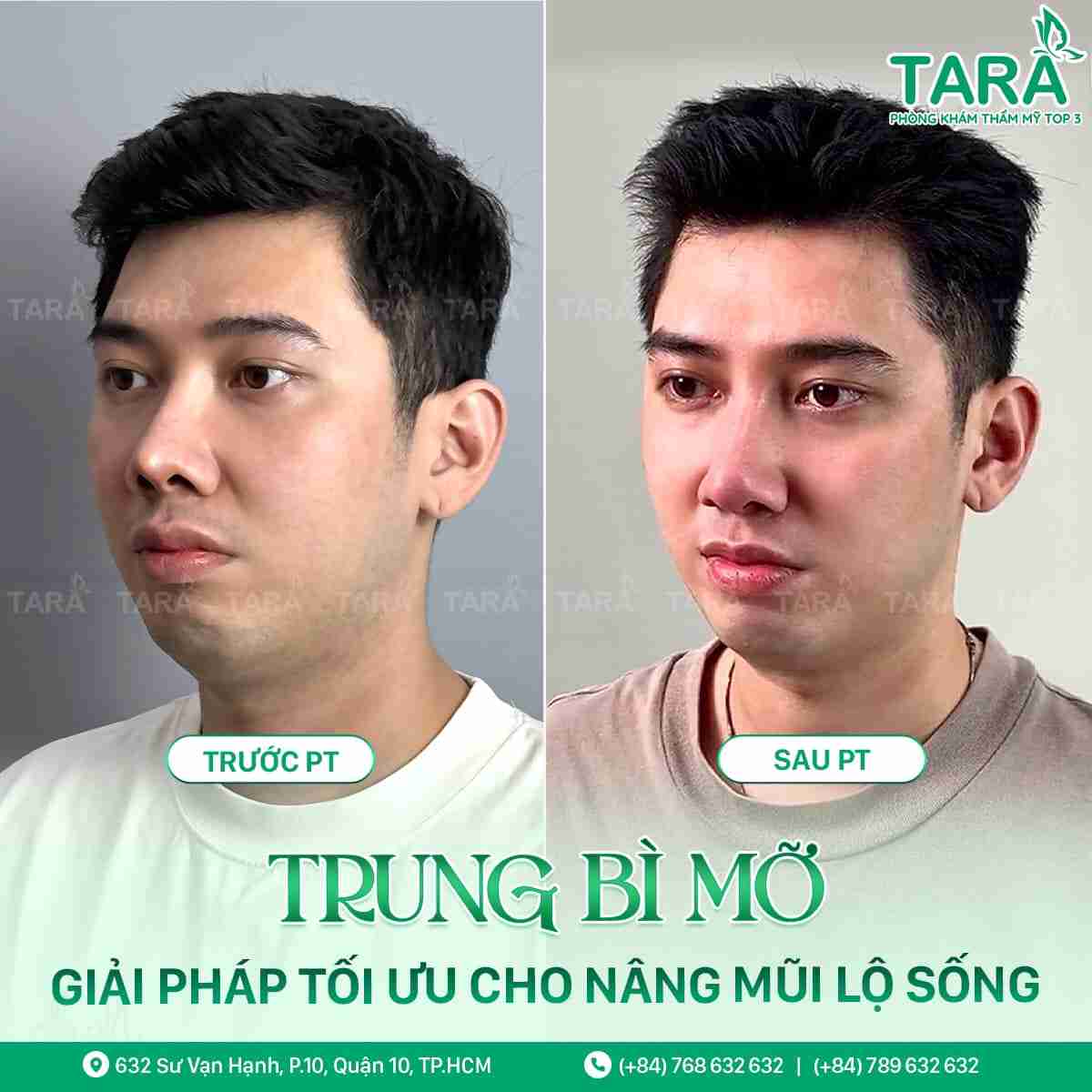 giá sửa mũi hỏng