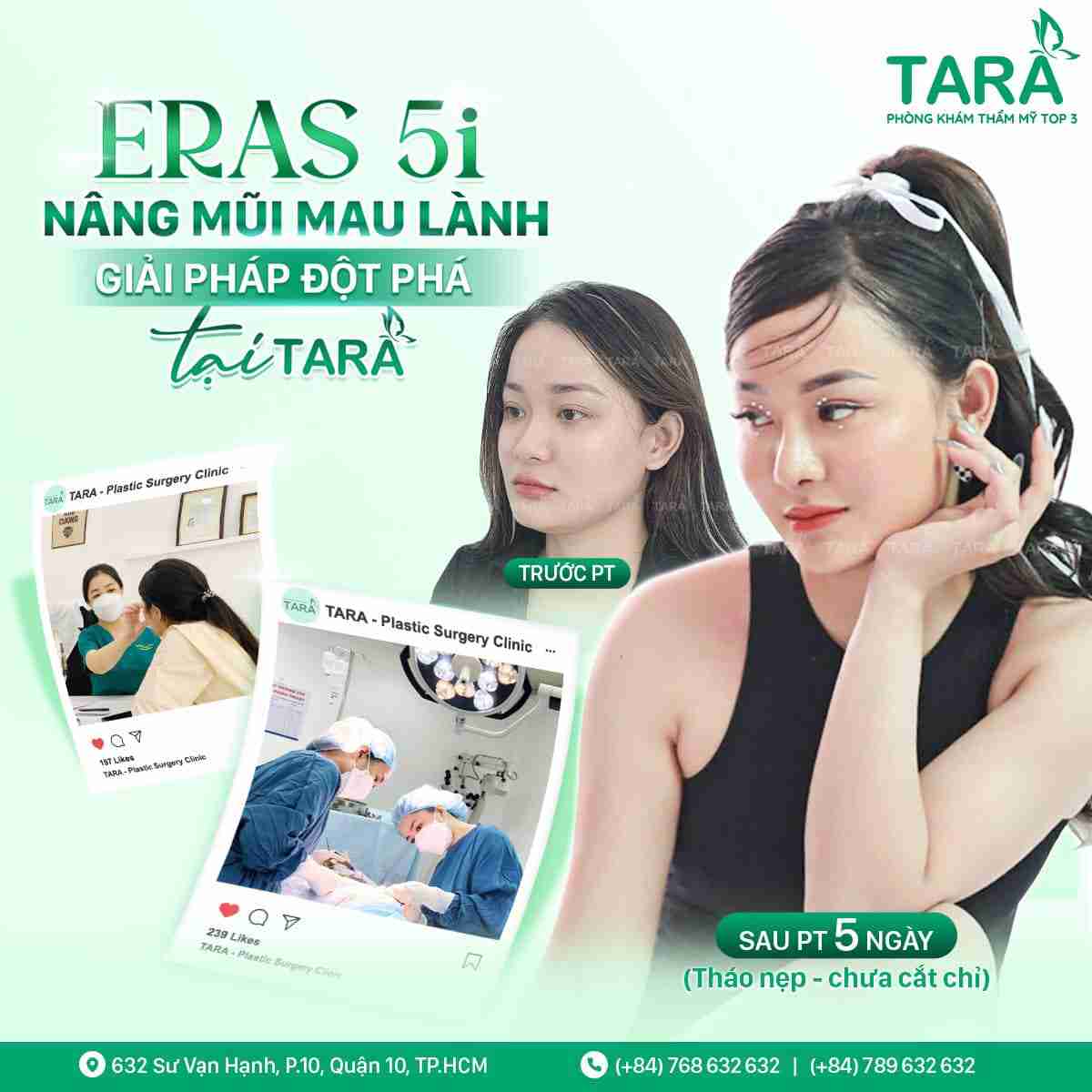 Nâng mũi sống surgiform Nâng mũi sống surgiform