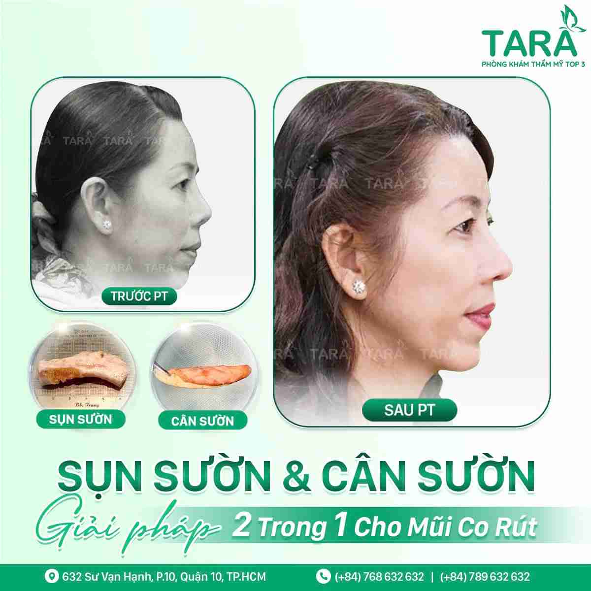 nâng mũi sụn tự thân nâng mũi sụn tự thân