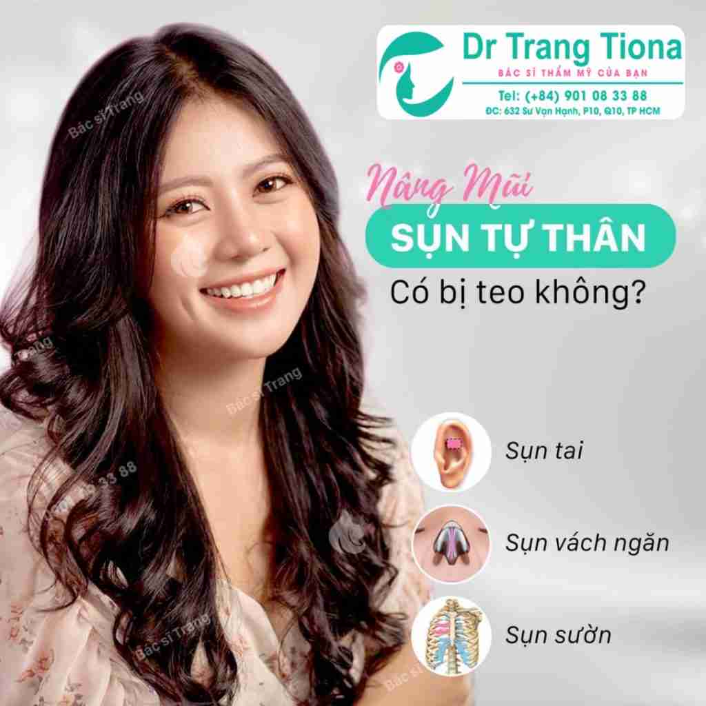 nâng mũi sụn sườn
