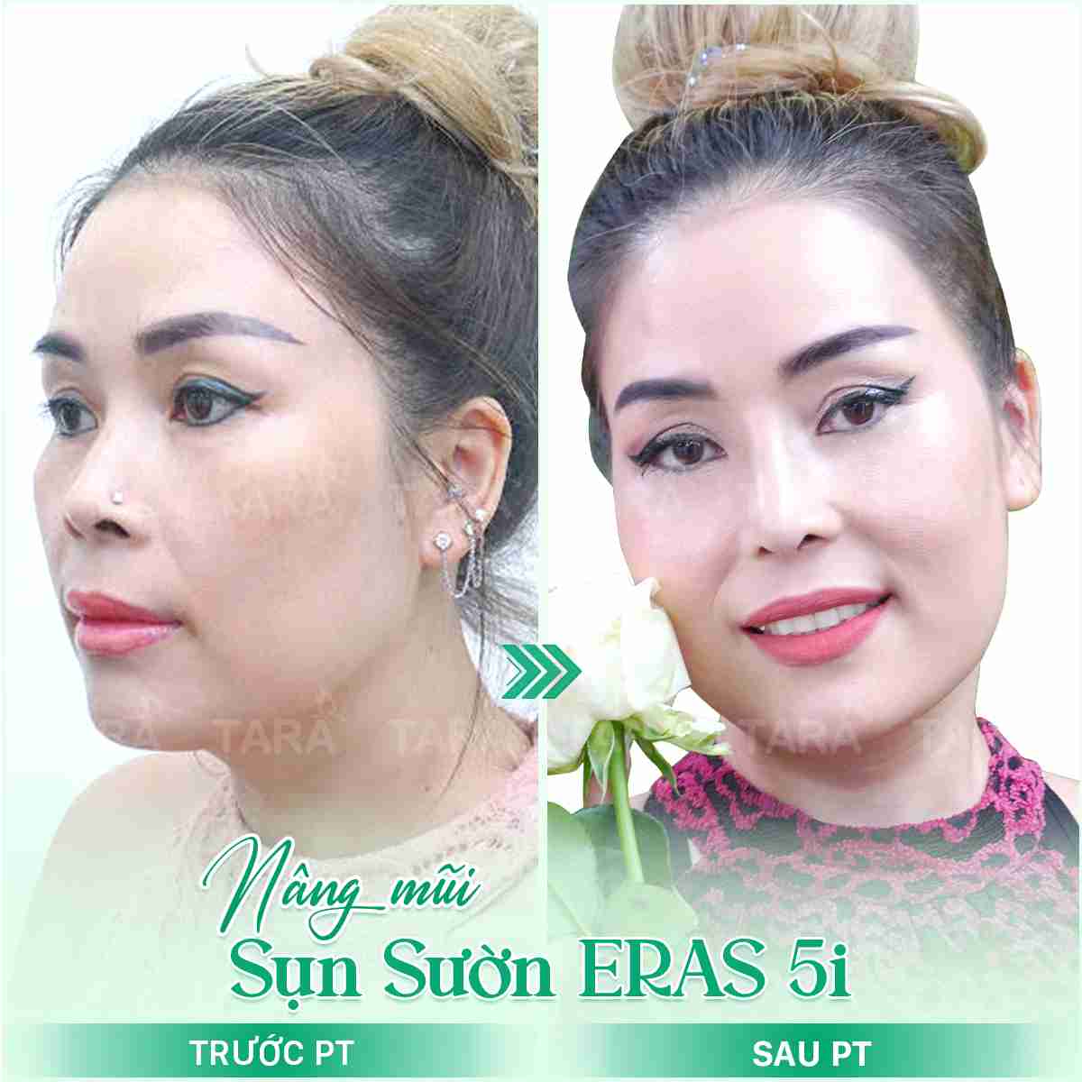 giá sửa mũi hỏng