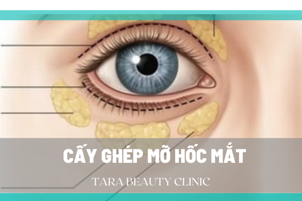 cấy mỡ hốc mắt