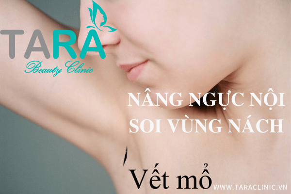 nâng ngực nội soi vùng nách