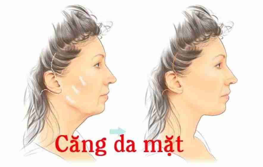 căng da mặt