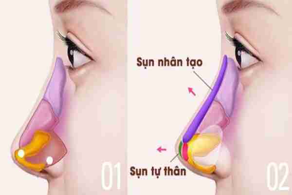 nên nâng mũi bằng sụn tự thân hay nhân tạo