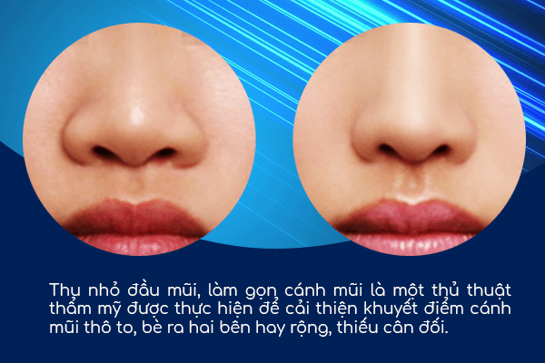 thu gọn cánh mũi đầu mũi
