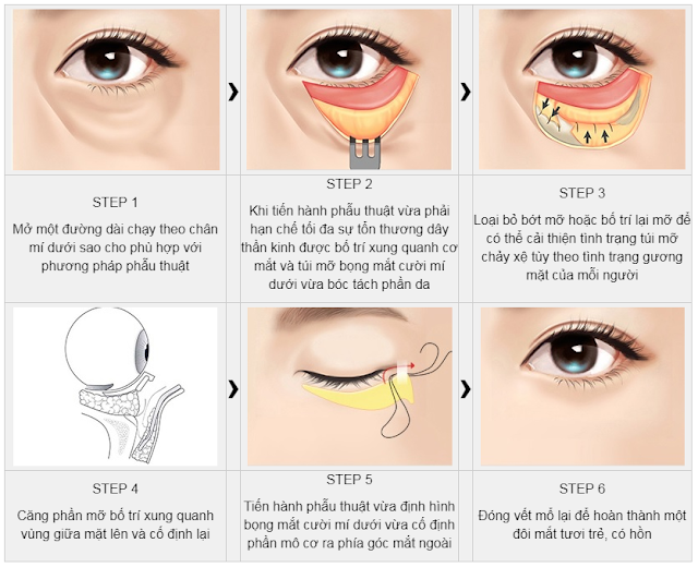 lấy mỡ bọng mắt