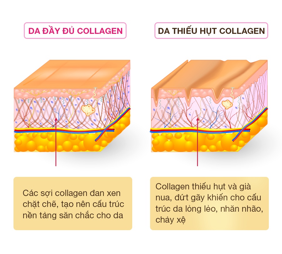 xóa rãnh lệ bằng phẫu thuật thẩm mỹ