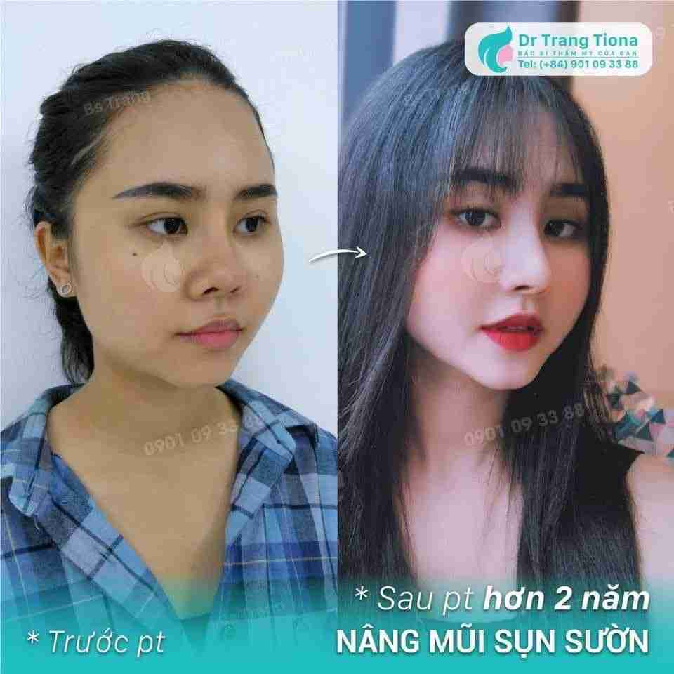 Có nên nâng mũi không