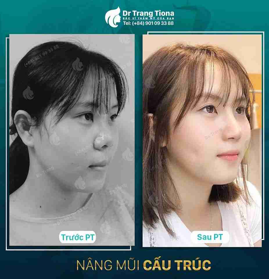 Kinh nghiệm chăm sóc sau nâng mũi
