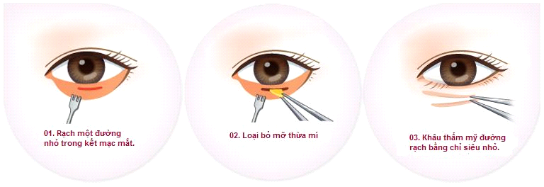 lấy mỡ bọng mắt