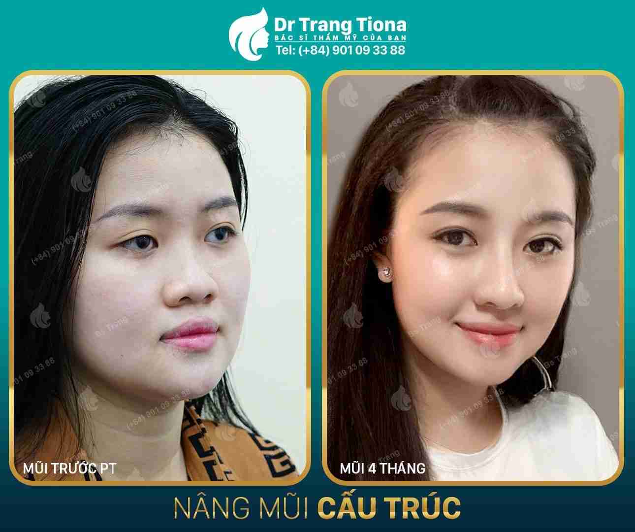 Có nên nâng mũi không