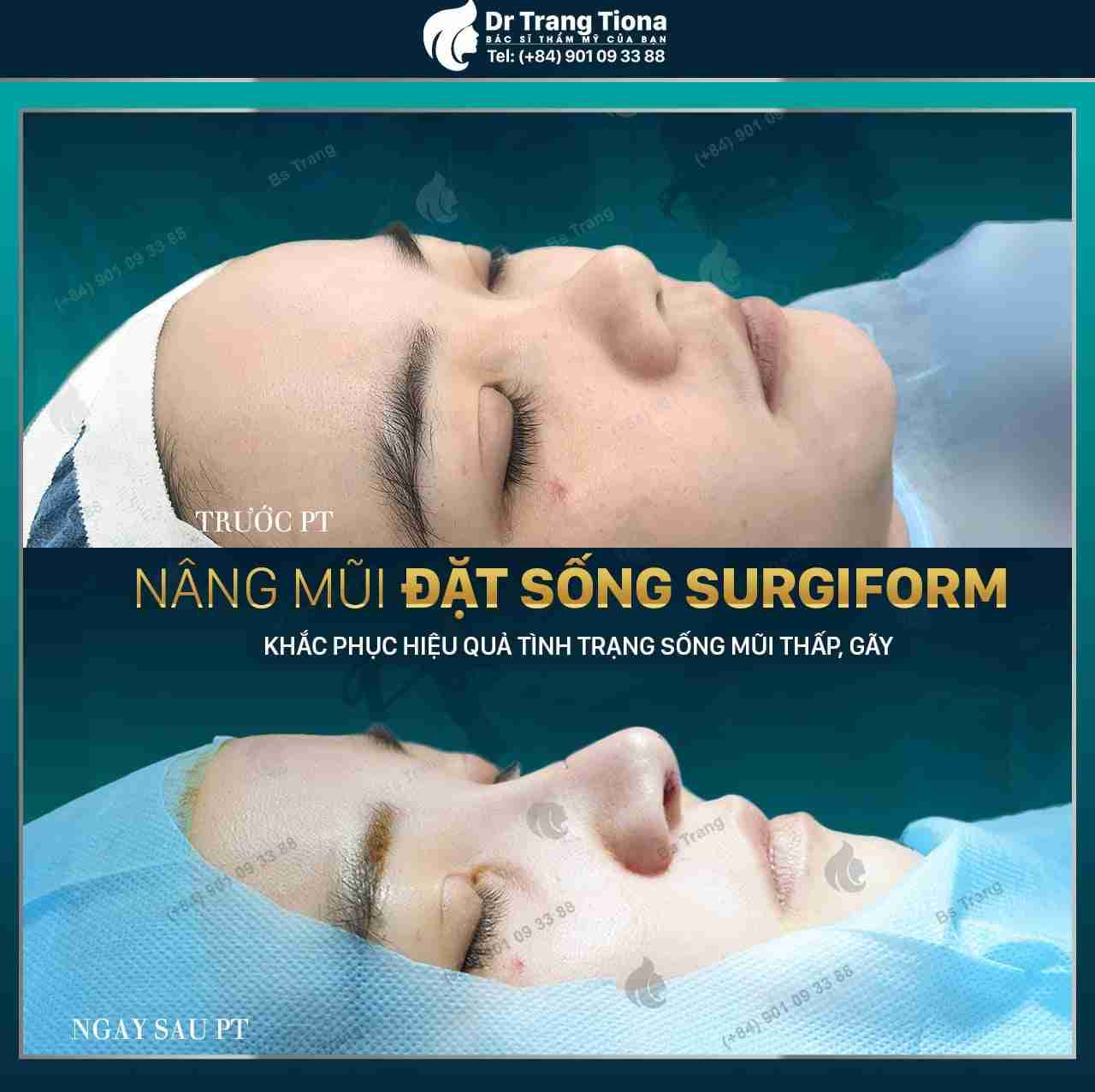 Nâng mũi sống surgiform