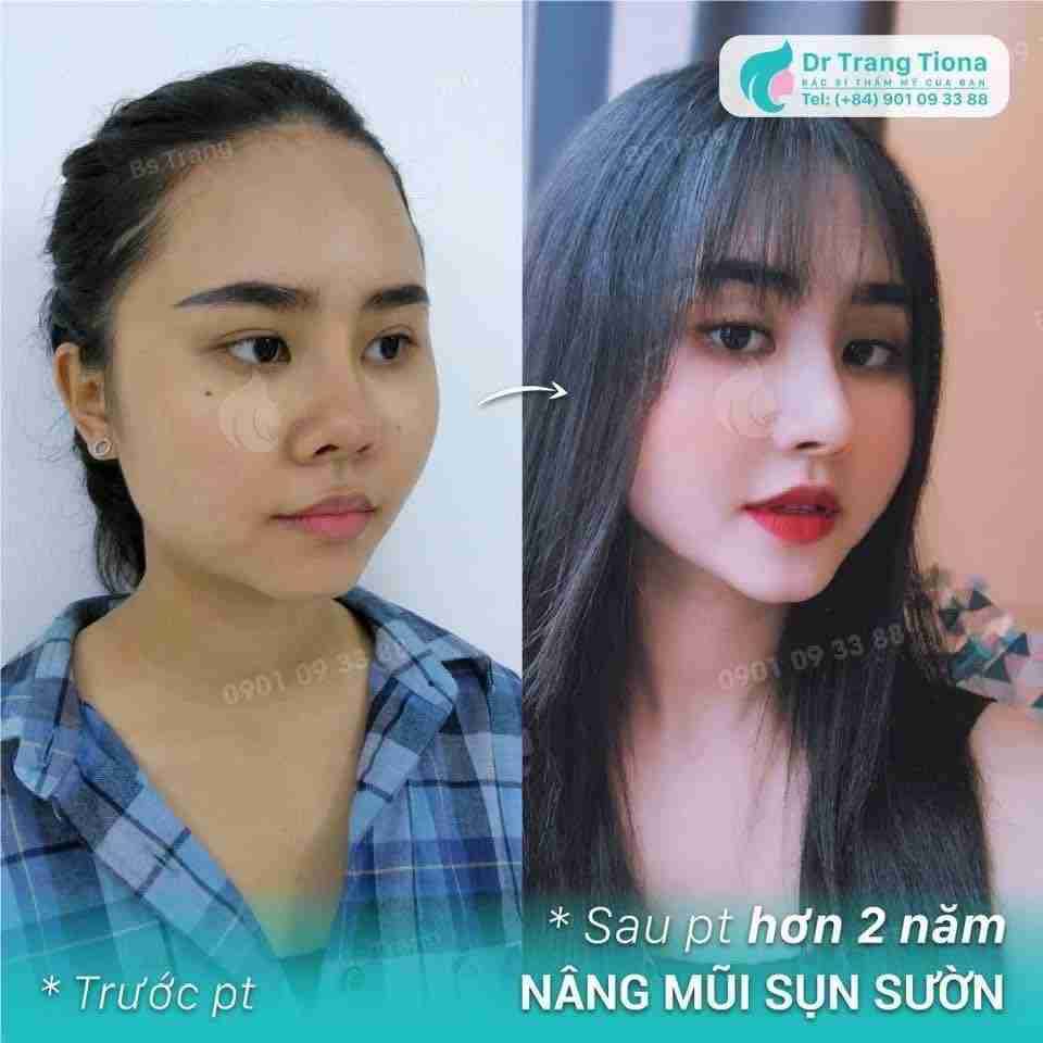 chỉnh sửa mũi lân 