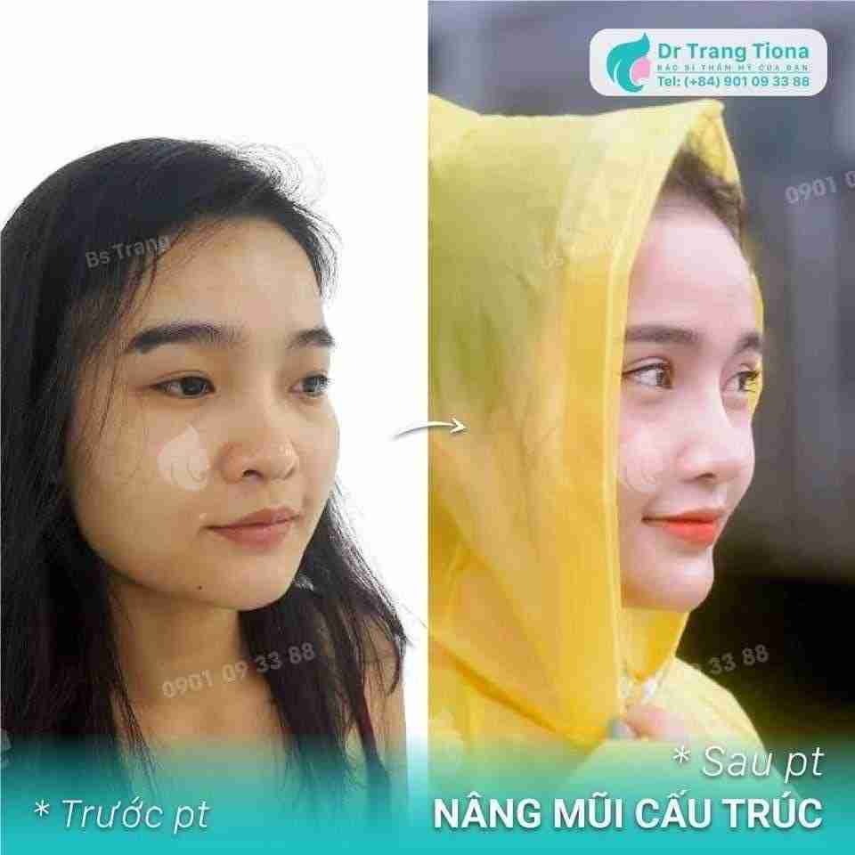 Nâng mũi có vĩnh viễn không