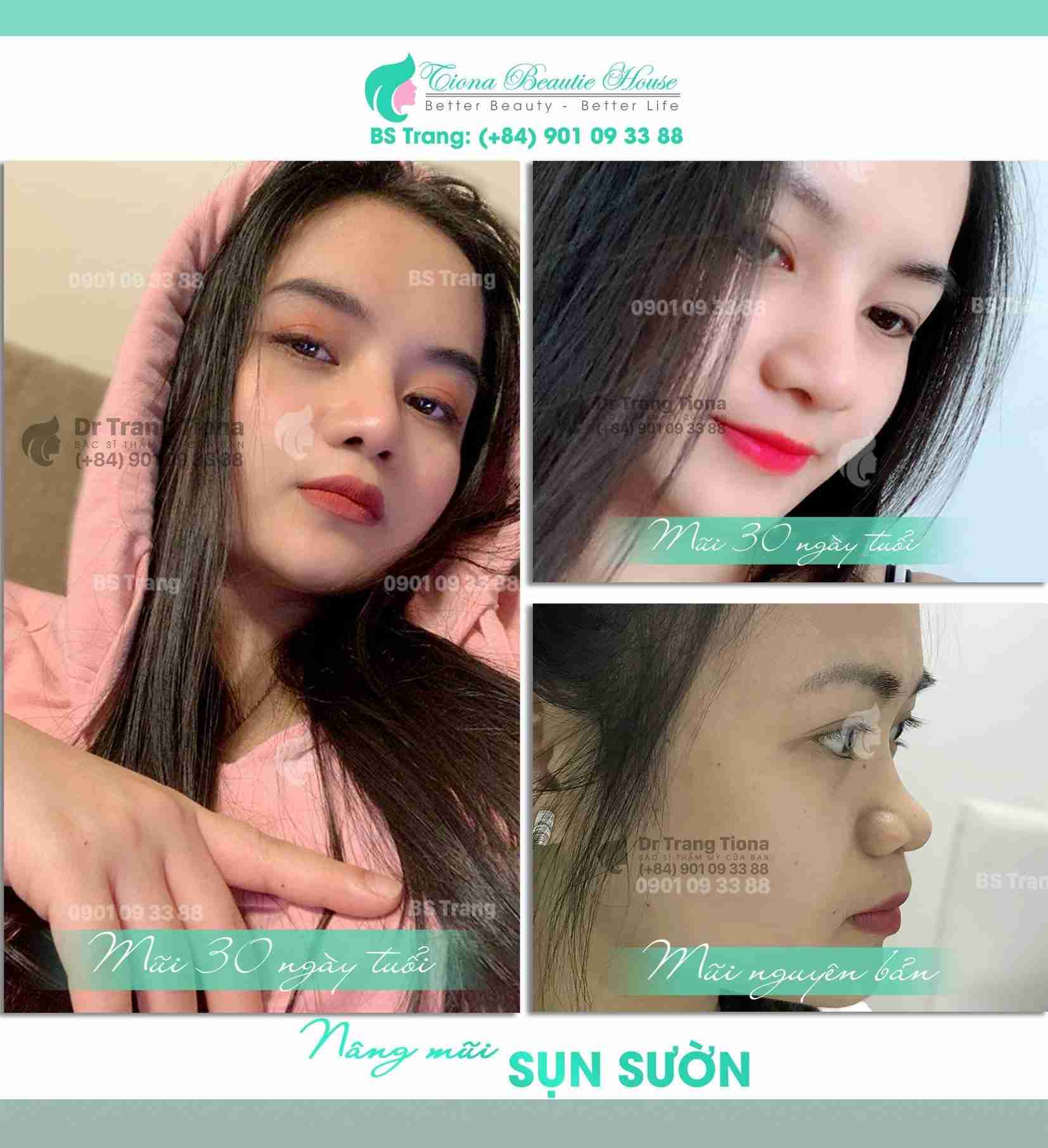 Phẫu thuật sửa mũi rồng