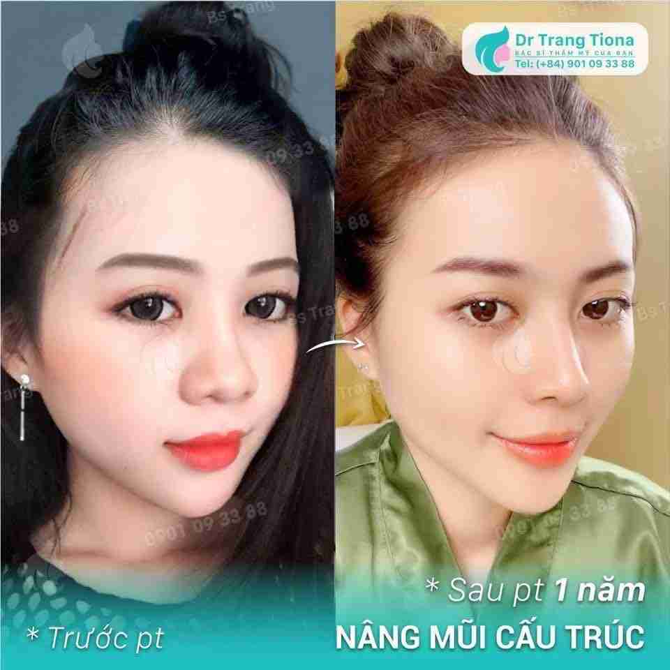 Phẫu thuật sửa mũi rồng