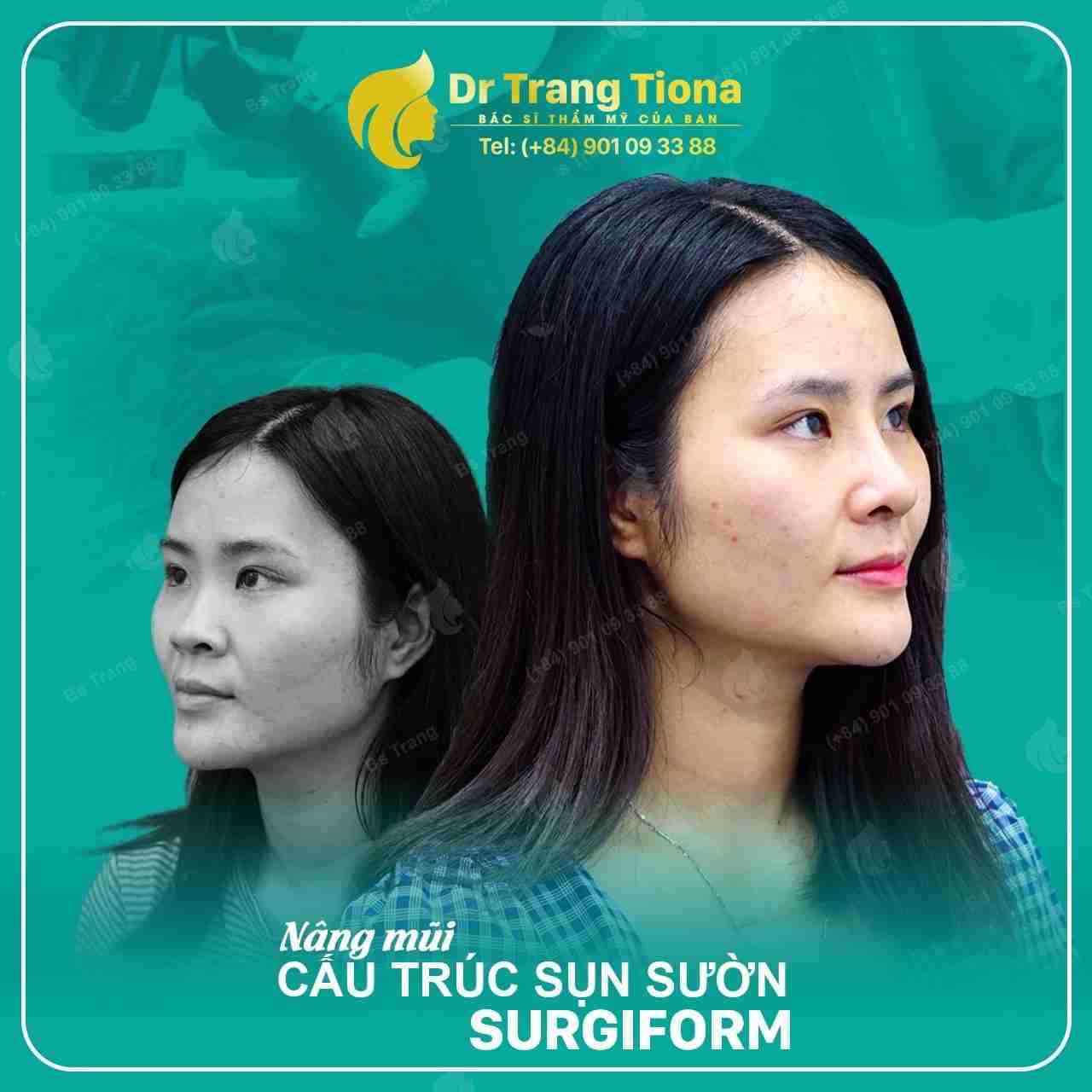 Phẫu thuật sửa mũi xấu