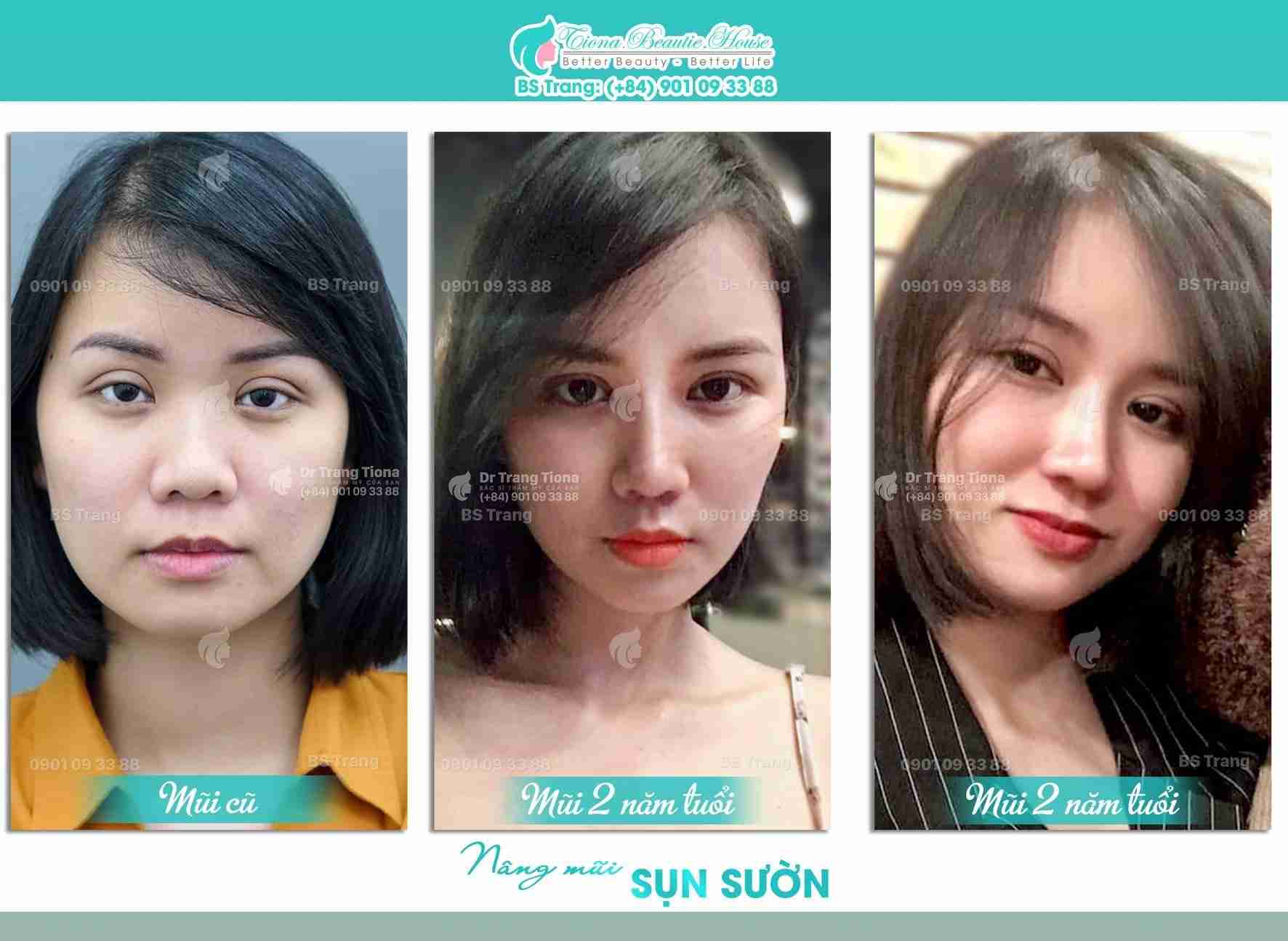 Phẫu thuật sửa mũi xấu