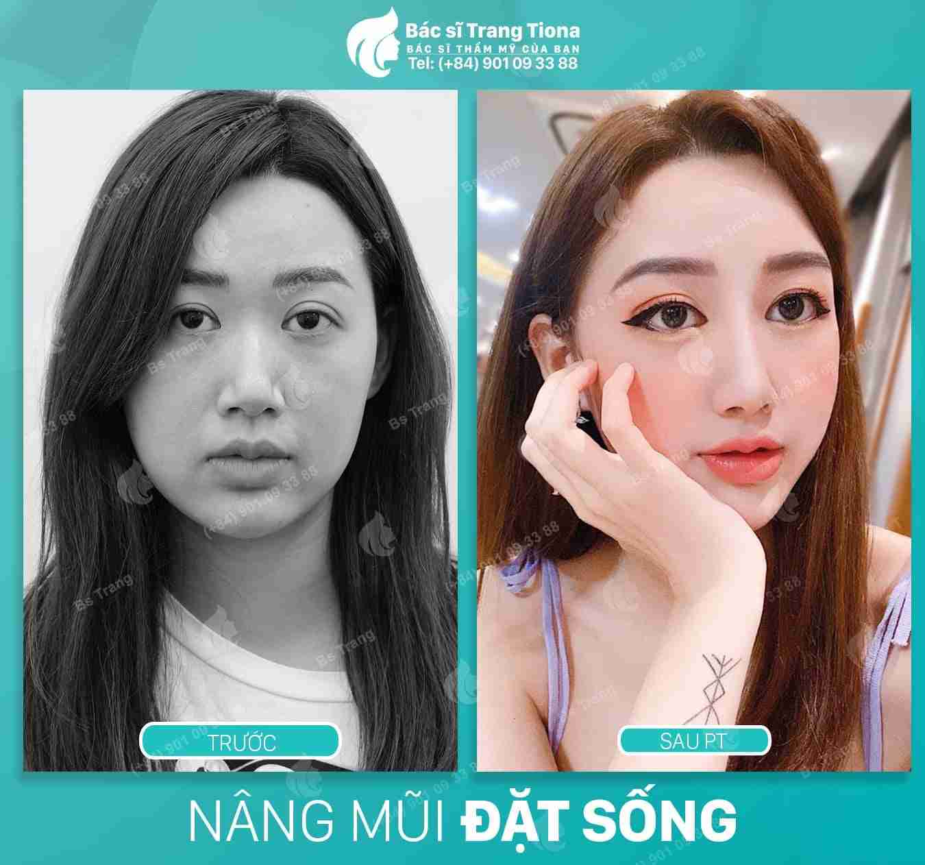 phẫu thuật tướng mũi giàu