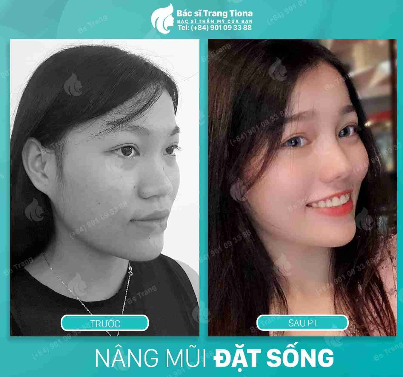 phẫu thuật tướng mũi giàu