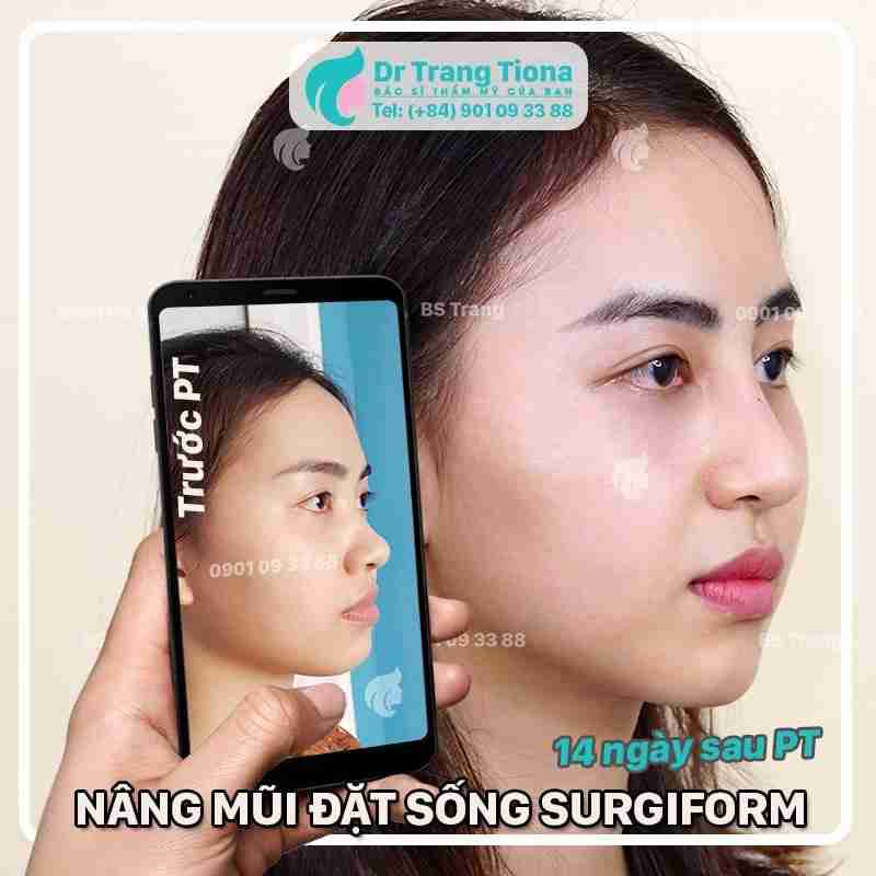 phẫu thuật tướng mũi giàu