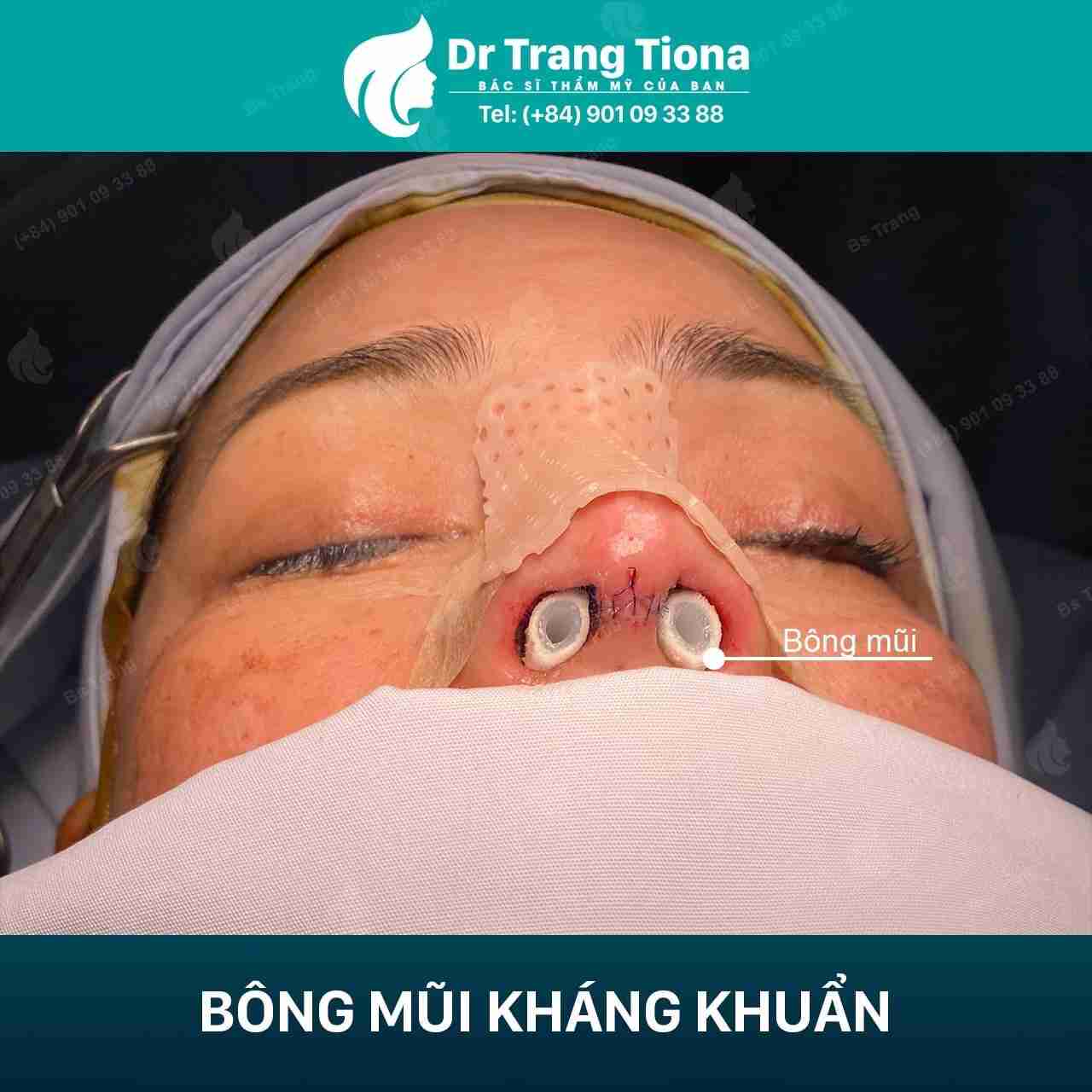 Thế nào là quy trình nâng mũi đạt chuẩn