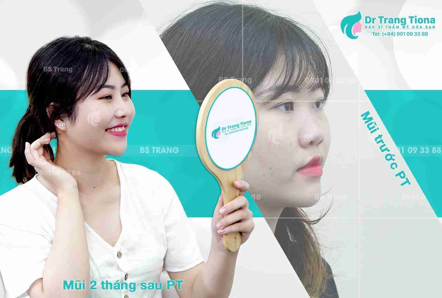 nâng mũi đạt chuẩn