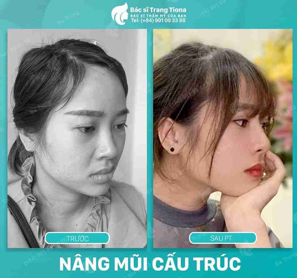 Thế nào là quy trình nâng mũi đạt chuẩn